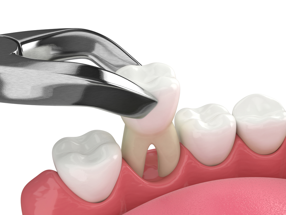 Dental Extractions in Davis, CA. Dr. Amir Nojouimi, Dr. Pouya Namiranian. Davis Oral Surgery & Implant Center