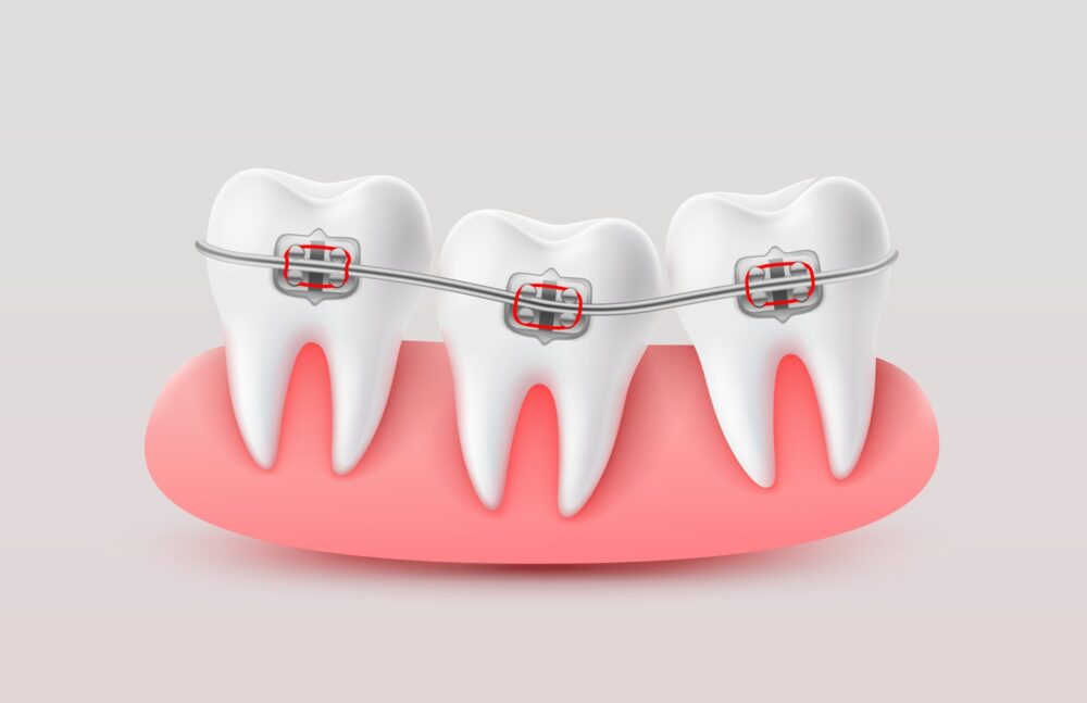 Surgically Assisted Orthodontics in Davis, CA. Dr. Amir Nojouimi, Dr. Pouya Namiranian. Davis Oral Surgery & Implant Center