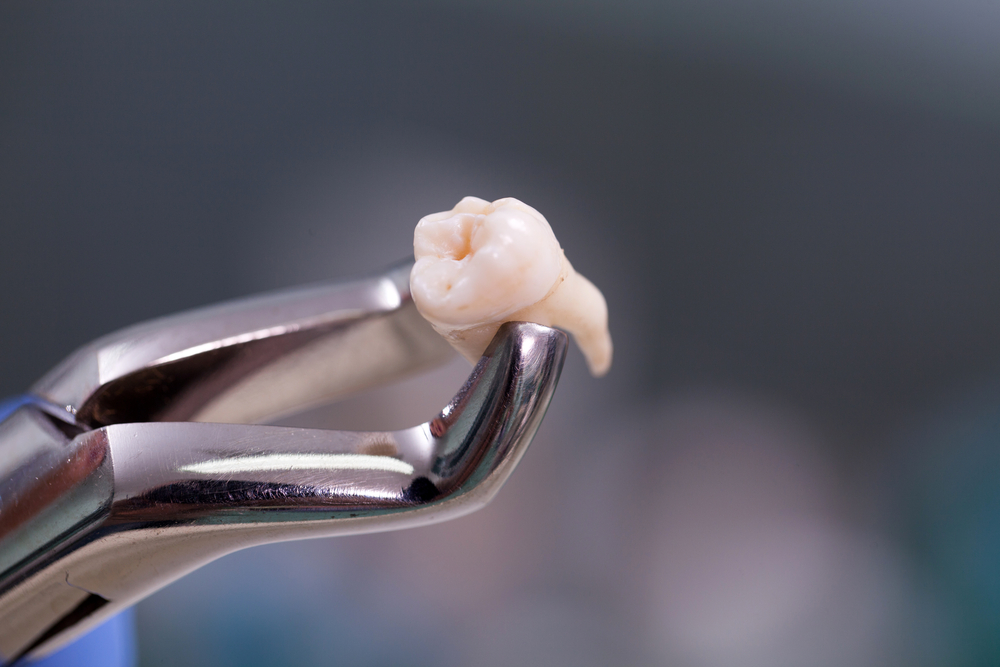 Wisdom Tooth Extraction in Davis, CA. Dr. Amir Nojouimi, Dr. Pouya Namiranian. Davis Oral Surgery & Implant Center