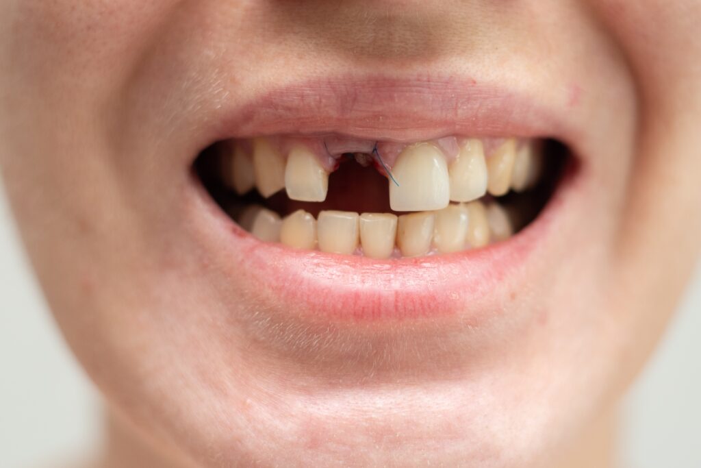 Bone grafting Davis