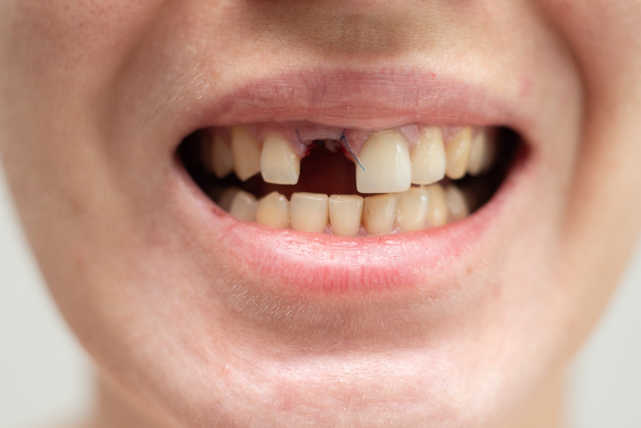 Bone grafting Davis